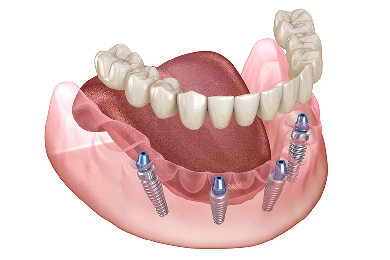 All on Four Dental Implants in Brockport