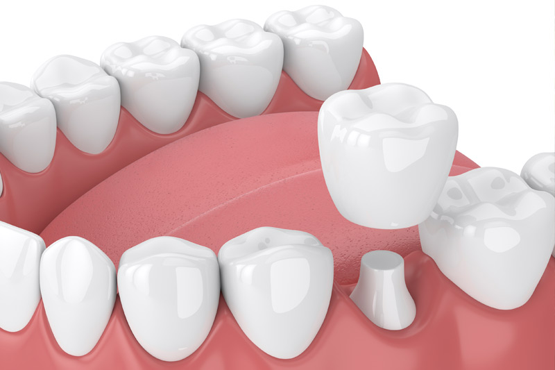 Dental Crowns in Brockport