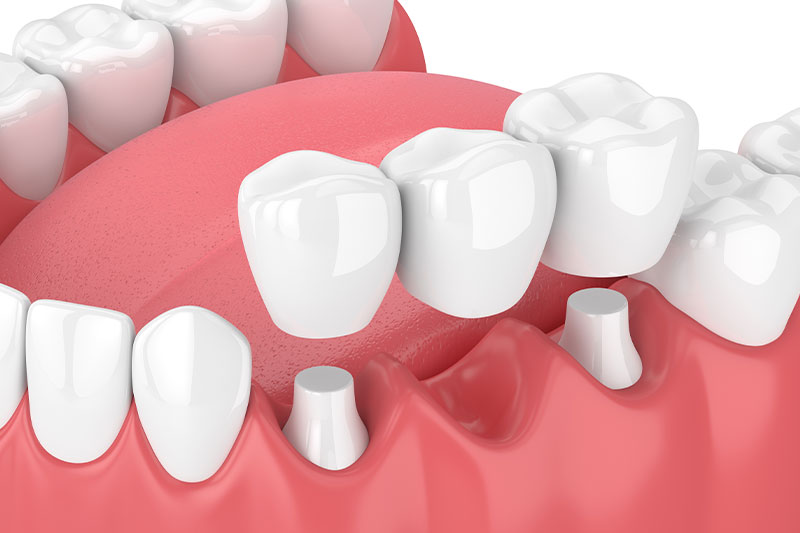 Dental Bridges in Brockport