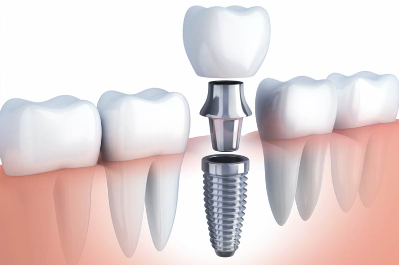 Dental Implants in Brockport