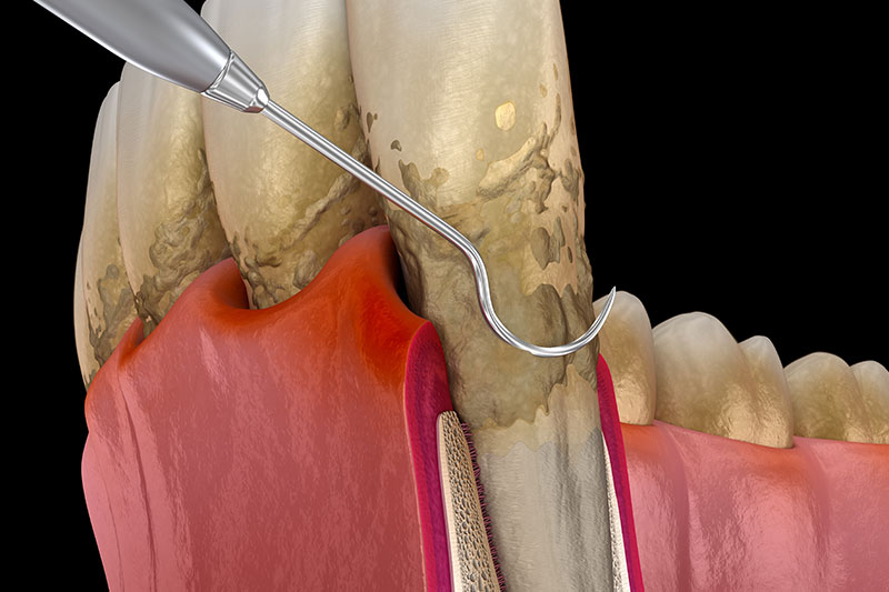 Gum Therapy (Periodontal Therapy) in Brockport